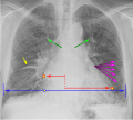 Annotated with signs of heart failure - vector (.svg) version