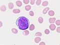 Blast cell from a case of acute promyelocytic leukemia. Wright's stain