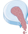 Disc herniation - Sequestration