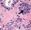 Acinar adenocarcinoma of the prostate with multiple nucleoli