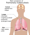 Pulmonary tuberculosis symptoms