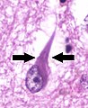 Neurofibrillary tangles - annotated, by Mikael Häggström, Public Domain