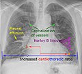 Annotated with signs of heart failure - raster (.jpg) version