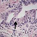 Adenocarcinoma of the prostate with two mitoses in reactive epithelium