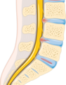 Disc herniation