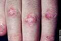 Gottron's papules: prominent atrophy, porcelain white scarring, and telangiectasia.