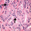 acinar adenocarcinoma of the prostate with double and marginated nucleoli