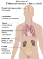 Extrapulmonary tuberculosis symptoms