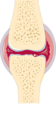 Osteoarthritis and rheumatoid arthritis - Rheumatoid arthritis