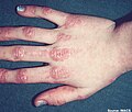 Gottron's papules: discrete erythematous papules.