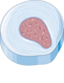 Disc herniation - Degeneration