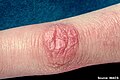 Gottron's papules: characteristic raised erythematous papules.