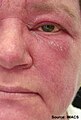 Malar and facial erythema. Facial edema and scale.