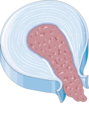 Disc herniation - Extrusion