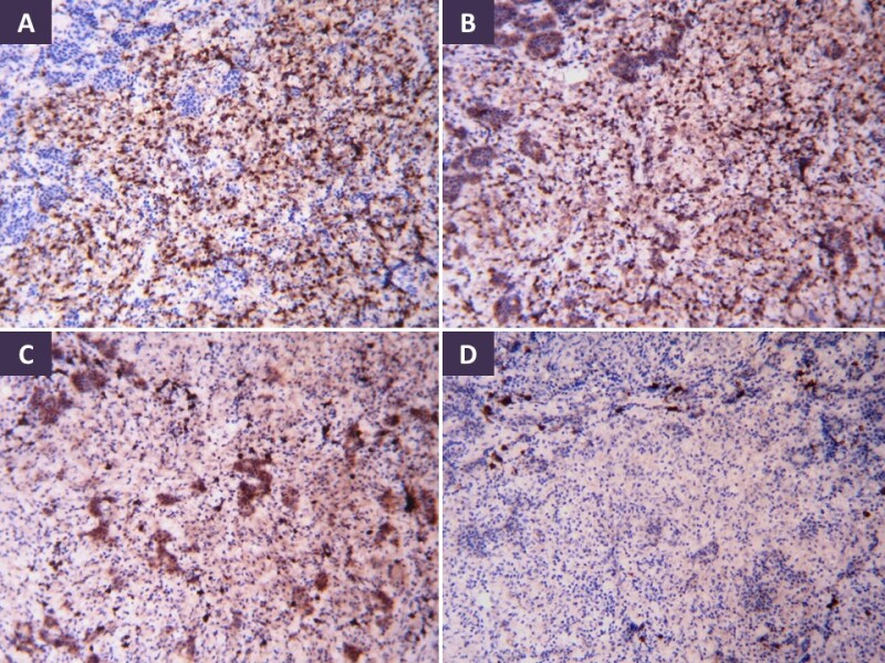 Figure 10. . Immunohistochemistry in pituitary tuberculous granulomas shows mixed inflammatory infiltrate made up of epithelioid histiocytes (CD68), T-lymphocytes (CD3), B-lymphocytes (CD20) and occasional plasma cells (CD138) (A-D, respectively).