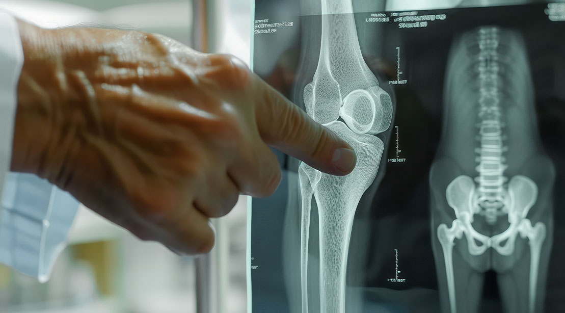 Medical professional examining a xray of the knee due to popping joints