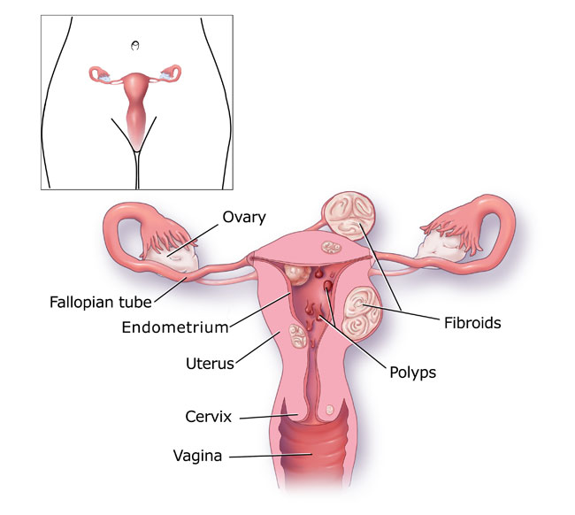 Menorrhagia CDC