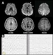 May 2: profile of patient with Creutzfeldt–Jakob disease