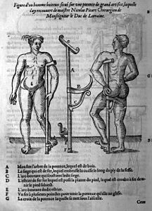 Ambroise Paré, Figure d'un homme boiteux situé sur une potence de grand artifice, 1585.