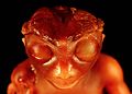 A front view of an anencephalic fetus