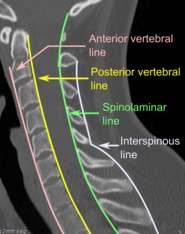 CT scan of normal congruous vertebral lines.[11]