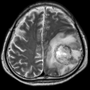 Thumbnail for Granulomatous amoebic encephalitis