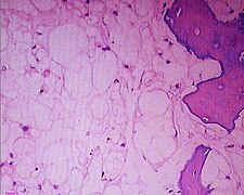 June 31: histopathology slide of chordoma