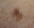 Melanoma in situ, left upper inner arm