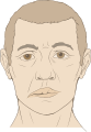 Bells palsy diagram.svg