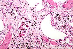 صورة مكبرة عن السحار الاسبست( مع وجود أجسام حديدية)، وهو نوع من تغبر الرئة. صبغة H&E.