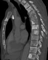 Skleroza kostiju grudnog dijela kičme, uslijed metastaza karcinoma prostate (CT-snimak)