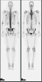 A nuclear medicine whole body bone scan. The nuclear medicine whole body bone scan is generally used in evaluations of various bone-related pathology, such as for bone pain, stress fracture, nonmalignant bone lesions, bone infections, or the spread of cancer to the bone.