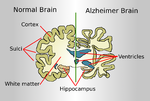 Thumbnail for Alzheimer's disease