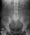 Two calcified fibroids (in the uterus)