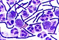 Gram-positive anthrax bacteria (purple rods) in cerebrospinal fluid: If present, a Gram-negative bacterial species would appear pink. (The other cells are white blood cells.)