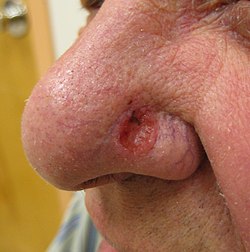 Basal_cell_carcinoma2.JPG