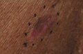 Melanoma, left mid-back marked for biopsy