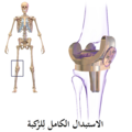 استبدال الركبة.