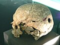 Human skull with trepanation, Celtic museum in Hallein (Salzburg)