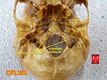 Occipital condyle.jpg