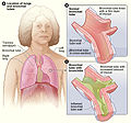 Thumbnail for File:Bronchitis.jpg