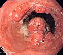 Endoscopisch verkregen beeld van een patiënt met een adenocarcinoom van de slokdarm aan de overgang met de maag.