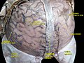 Meninges y venas cerebrales superficiales.Disección profunda.Vista superior.