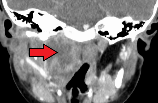 Large retropharyngeal abscess as seen on CT