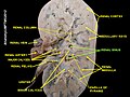 Renal sinus