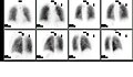 Normal pulmonary ventilation and perfusion (V/Q) scan. The nuclear medicine V/Q scan is useful in the evaluation of pulmonary embolism.