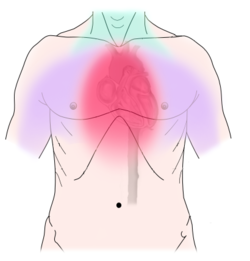 Angina során jelentkező mellkasi fájdalom kiterjedése