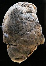 Thumbnail for File:Smoker's lungs.jpg