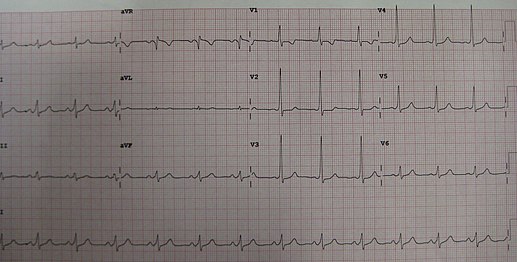 A short PR in Wolff–Parkinson–White syndrome