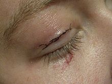 Eyelid's suture.jpg